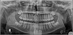 Πανοραμική-έγκλειστοι φρονιμήτες-οδοντιατρικη-κλινικη-αντζελα-ντουνη